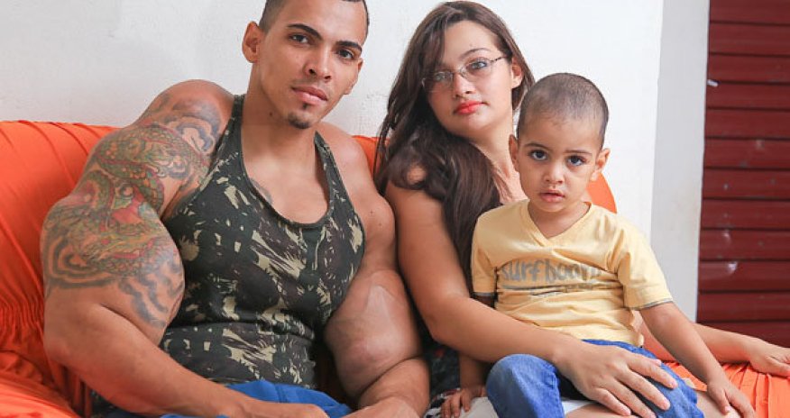 Bodybuilder with 25in biceps dances with death injecting fatal filler