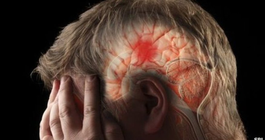 Strokes rising among people of working age, warns charity