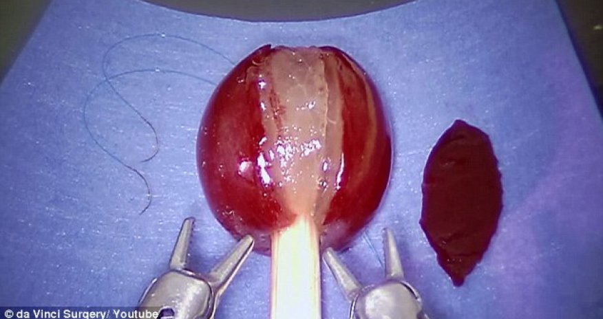 Robot used for removing tumors practices surgery