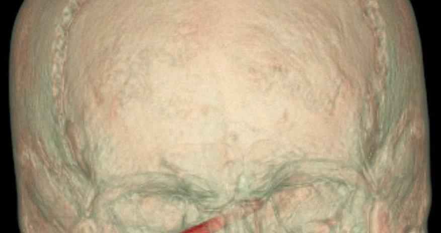 Miracle as gardener with a three inch NAIL stuck in his eye escapes with no sight damage