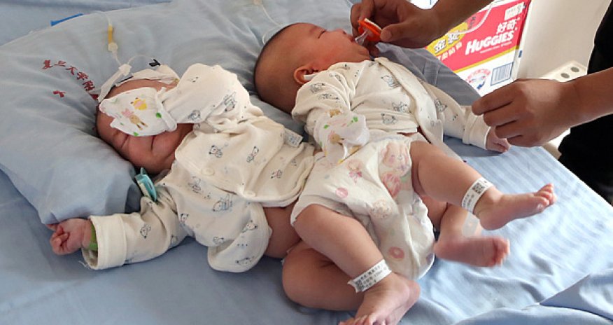 Doctors separate conjoined twins with help of 3D printer