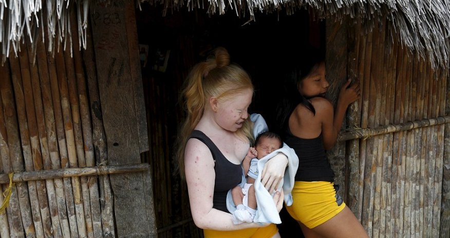Albino youngsters are forced to stay out of the bright sun in Panama village