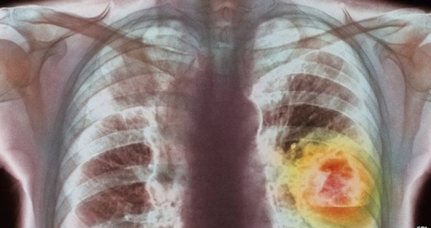New cancer strategy 'could save thousands'