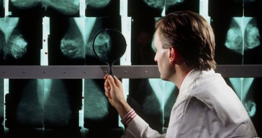 Drug could help slow half of breast cancers