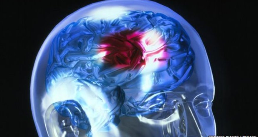 Clot-busting stroke drug safe, says expert review