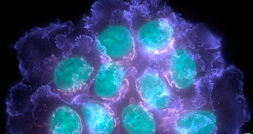 Cheap drugs cut breast cancer deaths by 18%