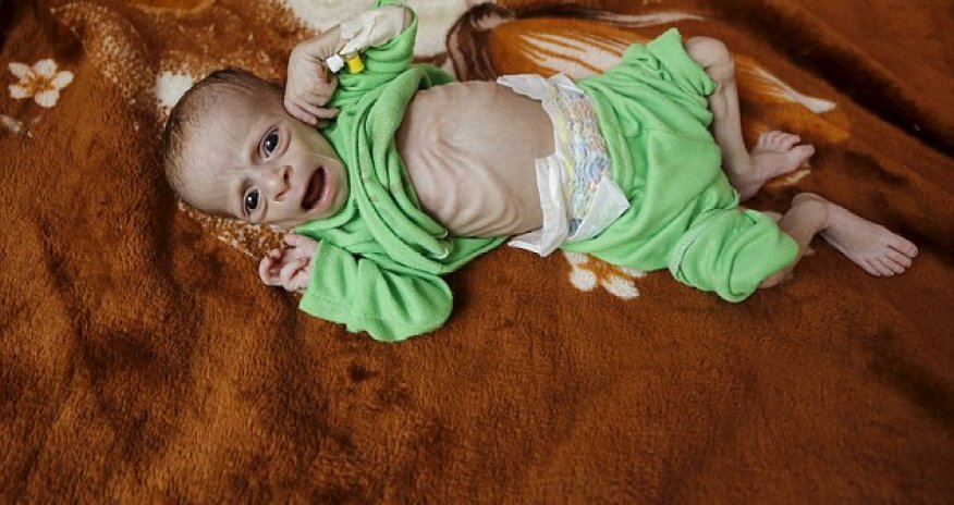 Heartbreaking images reveal the human face of hunger in Yemen