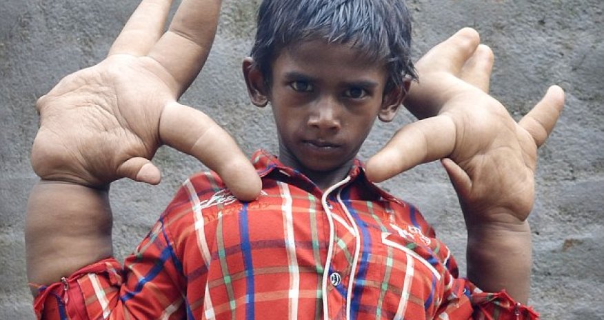 Hope for the boy with the world's biggest hands