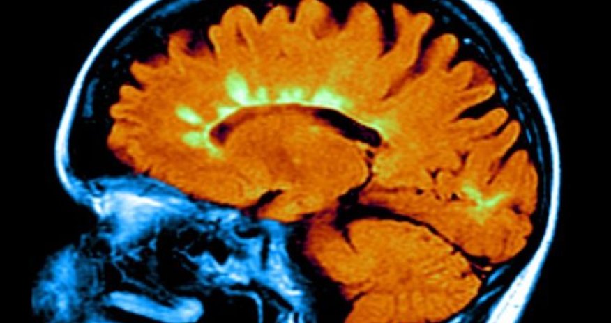 Low vitamin-D genes linked to MS