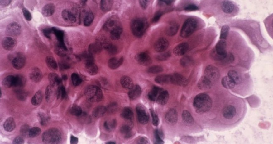 Blood test 'detects cancer relapse'