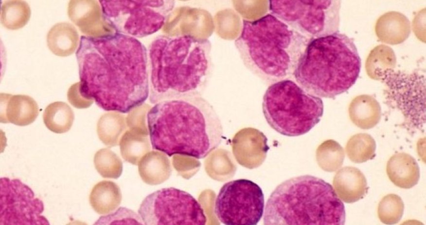 Diabetes drug may help in leukaemia