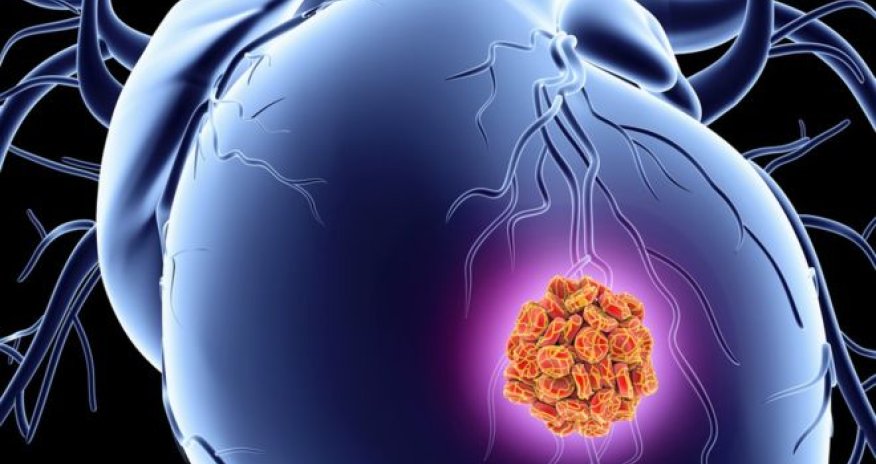 Patch may boost repair after heart attack