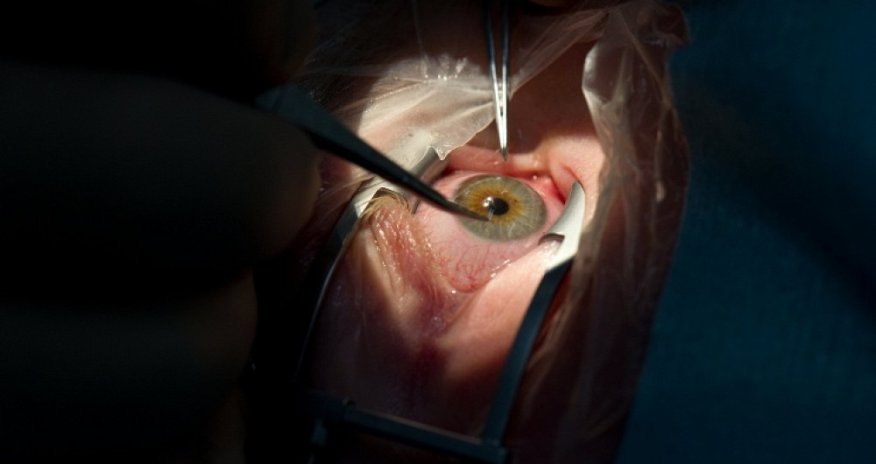 Göz qişasının köçürülməsində - İlk