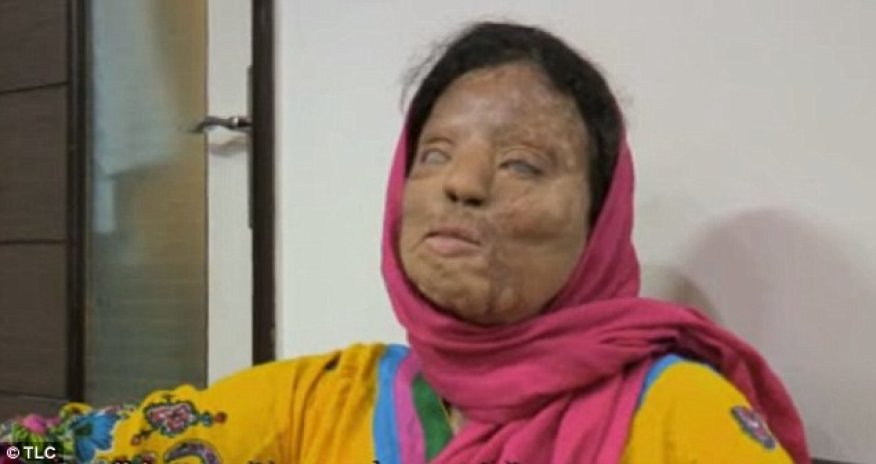 'It felt like I was being burned alive'