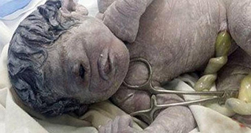 The tragic 'cyclops' baby born with one eye in the middle of his forehead