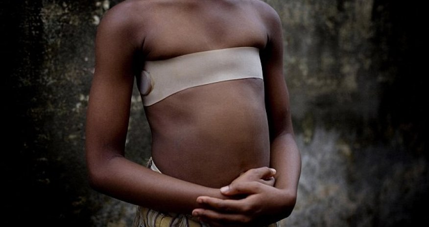 The terrifying rise of breast ironing