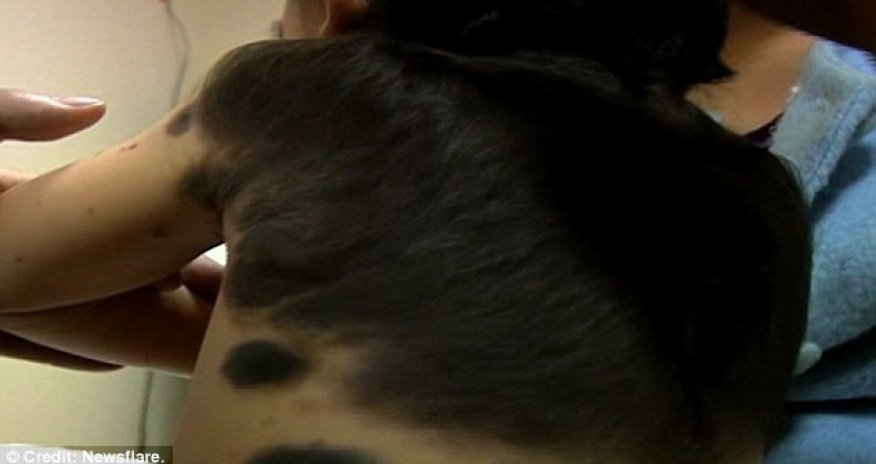 The boy with 'fur' growing on his back