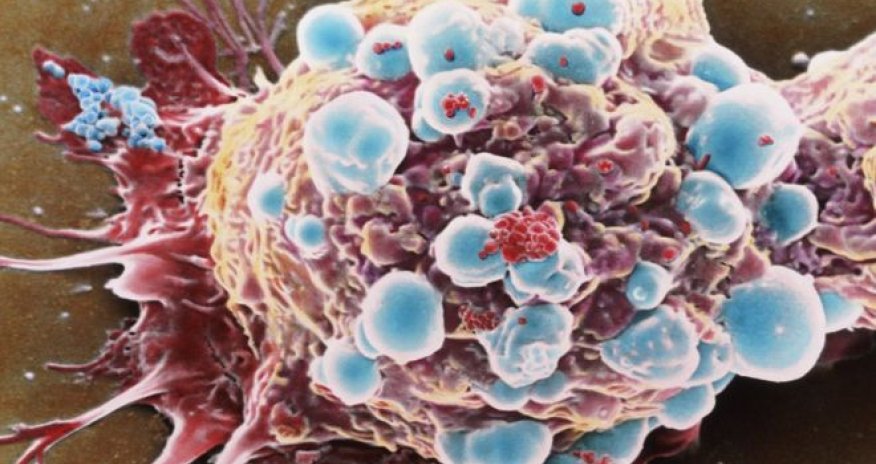 Cancer is not just 'bad luck' but down to environment