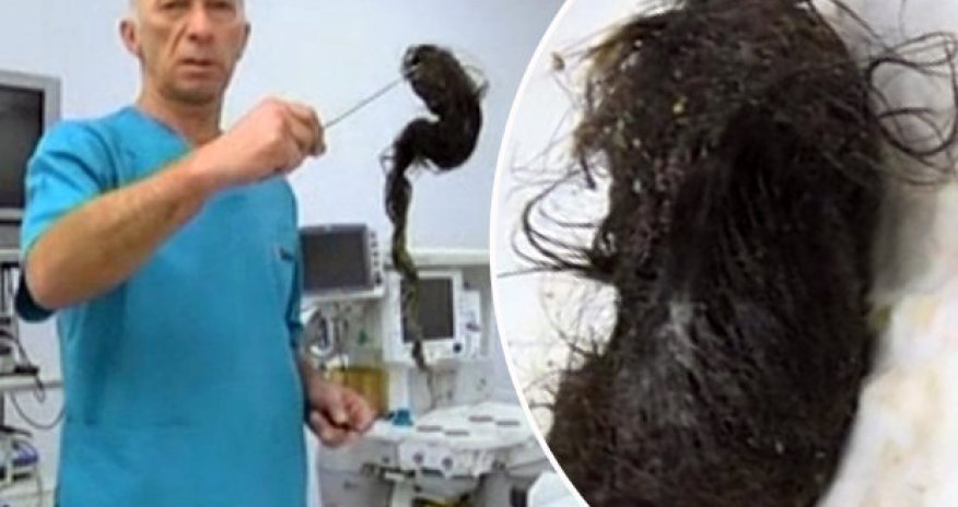 Stunned surgeons remove massive hairball from girl's stomach