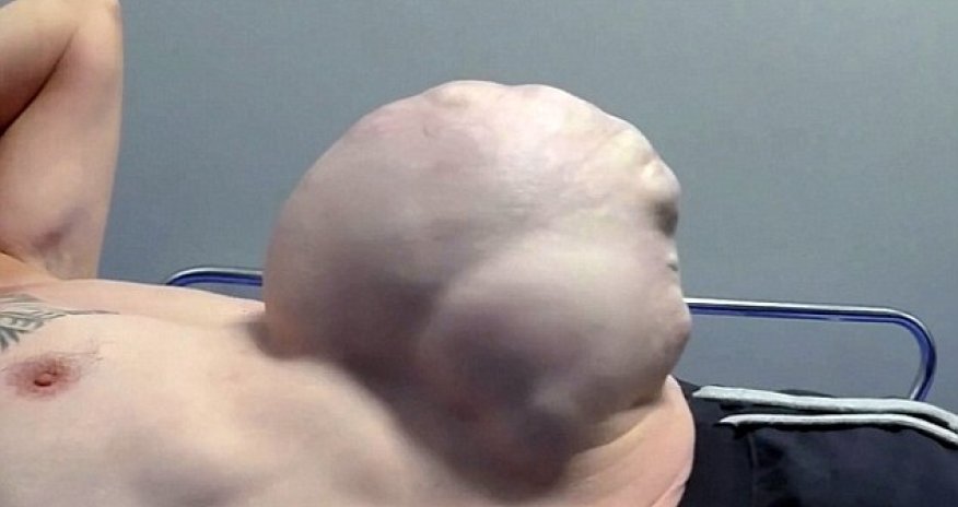 Pensioner who had hernia the size of a FOOTBALL