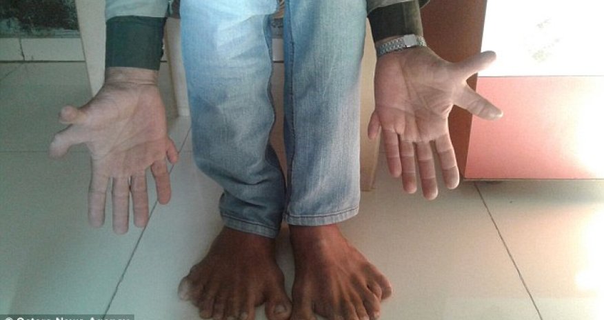 Indian carpenter with world record 28 fingers and toes
