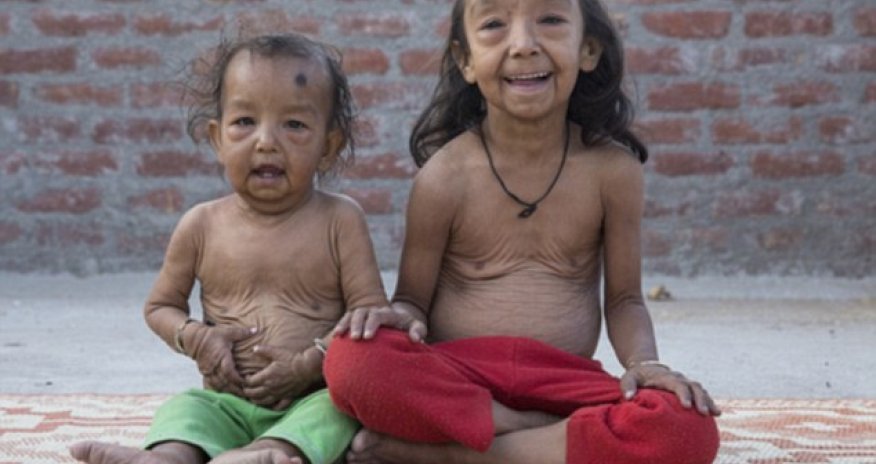 The extraordinary 'Benjamin Button' children