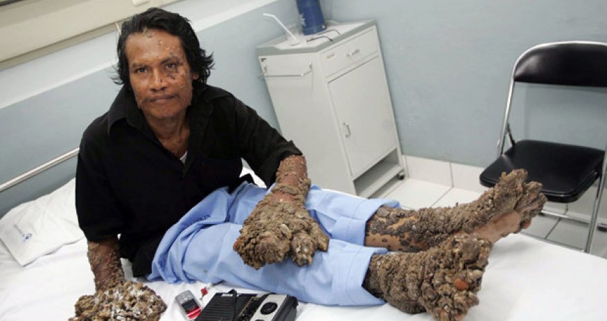 Man who suffered from limbs like TREE TRUNKS dies