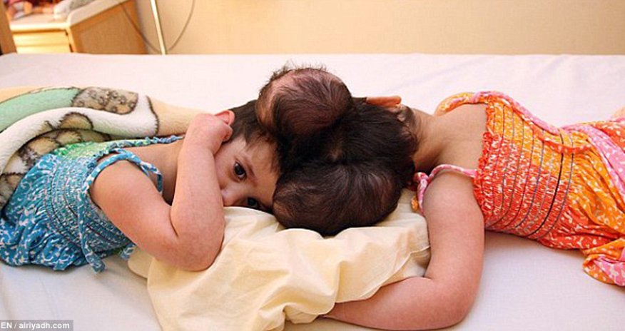 Twin four-year-old girls joined at the head are successfully separated