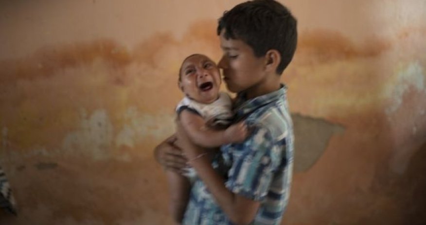 Zika virus: Study supports link to microcephaly