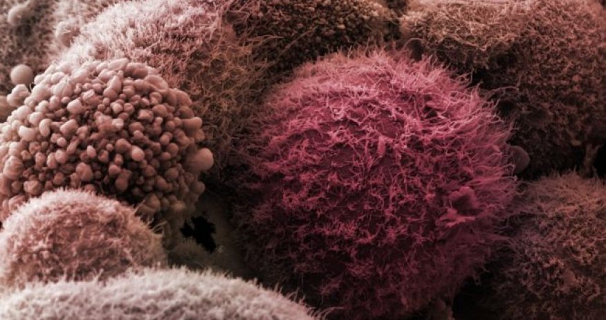Major insight into killer pancreatic cancer