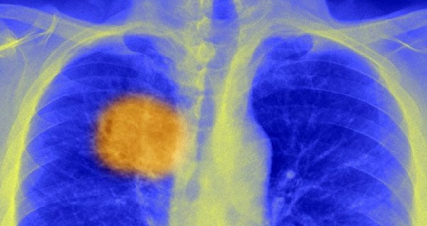 Scientists 'find cancer's Achilles heel'