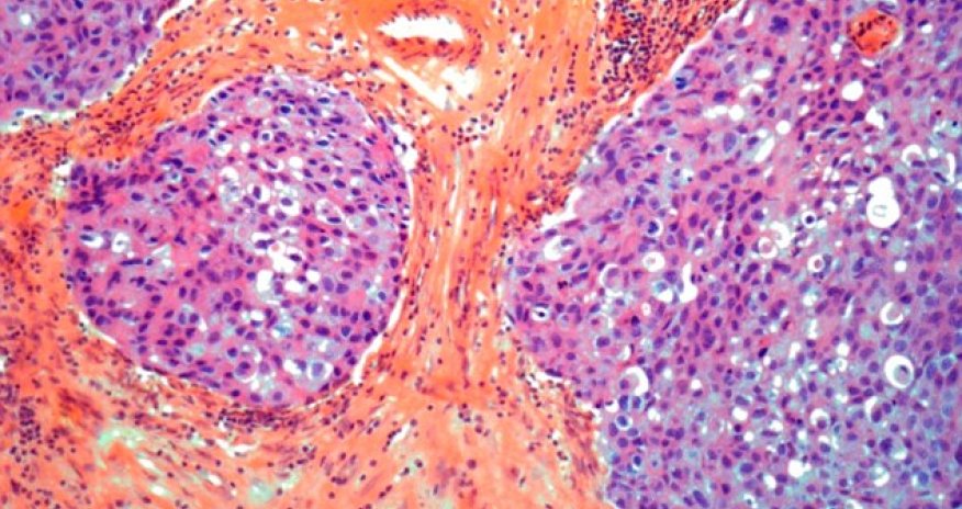 Terminal breast cancer could be wiped out by tweaking an EXISTING treatment