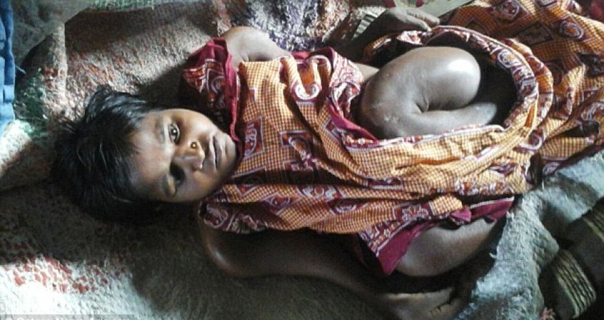 The 25-year-old who's the size of a TODDLER