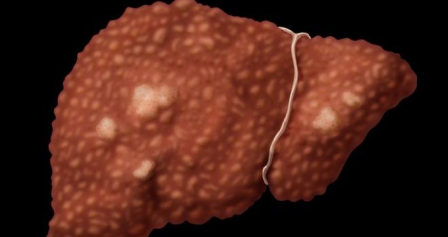 Viral hepatitis 'kills as many as Aids or TB'
