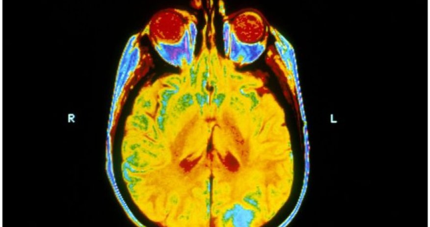 Brain radiotherapy 'no benefit' for lung cancer spread