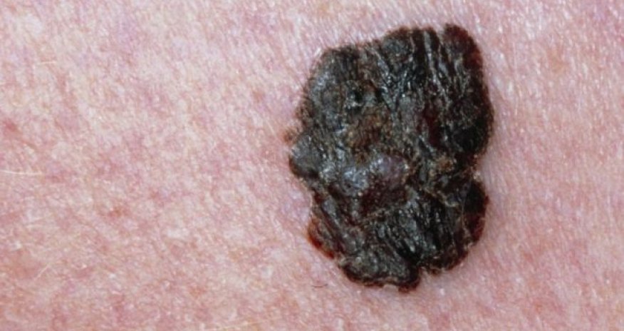 Artificial intelligence 'as good as cancer doctors'