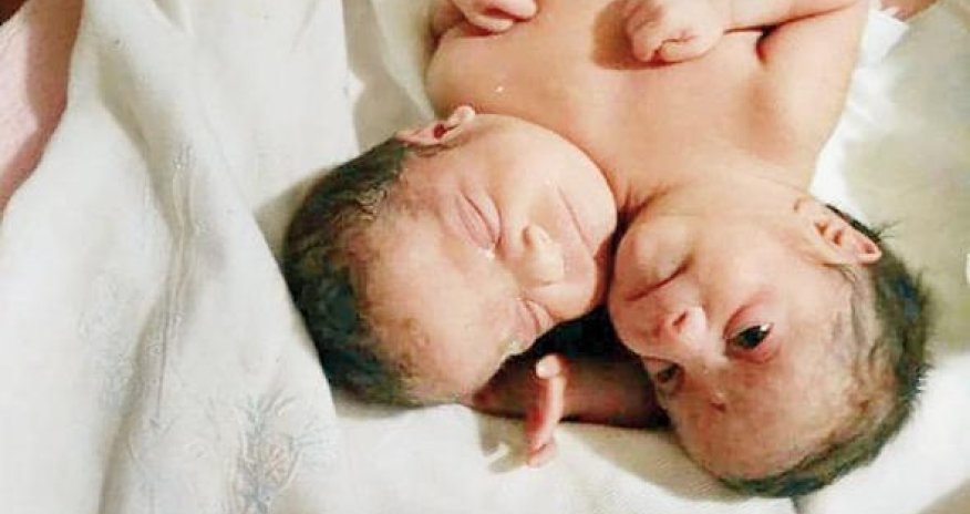 Bir bədənli, iki başlı əkizlər