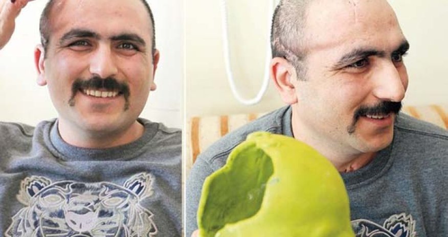 Aprel döyüşündə yaralanan hərbçiyə süni baş qapağı qoyuldu - FOTO