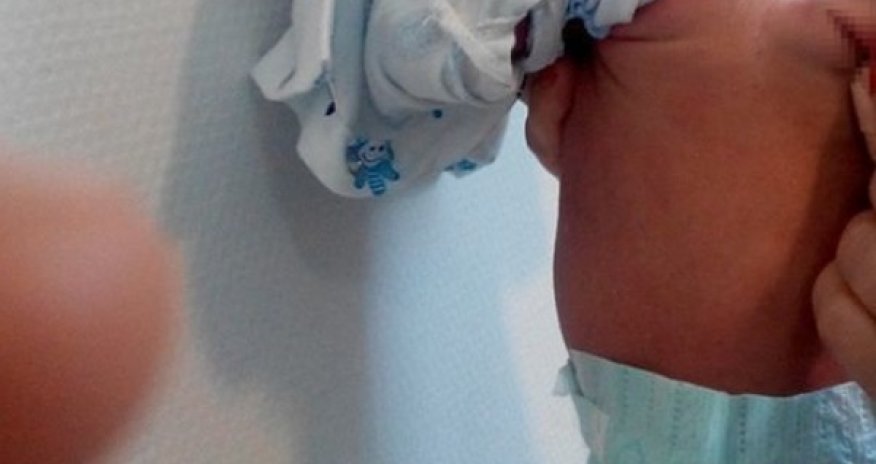 Azərbaycanda uşaq kürəyində cinsiyyət orqanı ilə doğuldu – FOTO