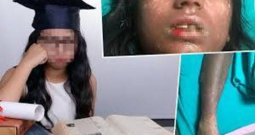 Həkimin yazdığı dərman 15 yaşlı qızcığazı bu hala gətirdi - FOTO