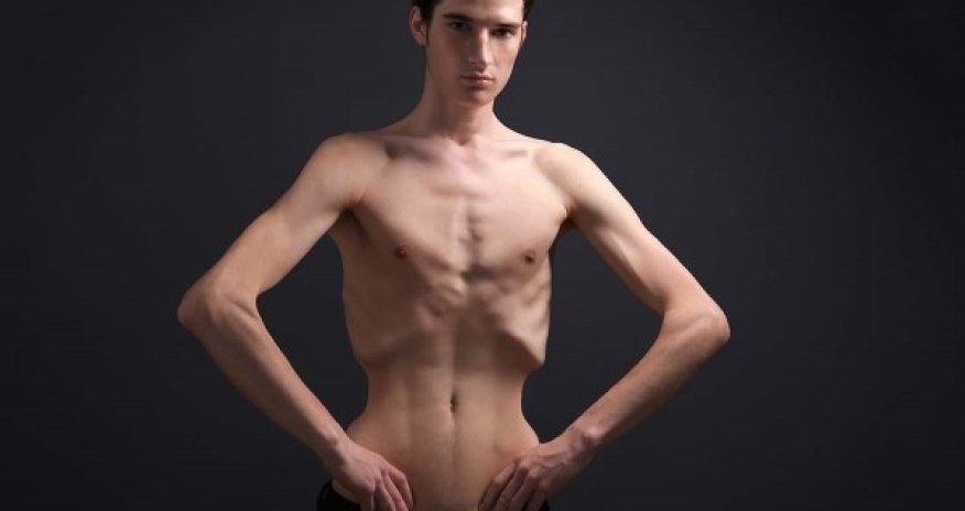 5 təhlükəli səbəb - İnsanı arıqladan xəstəliklər