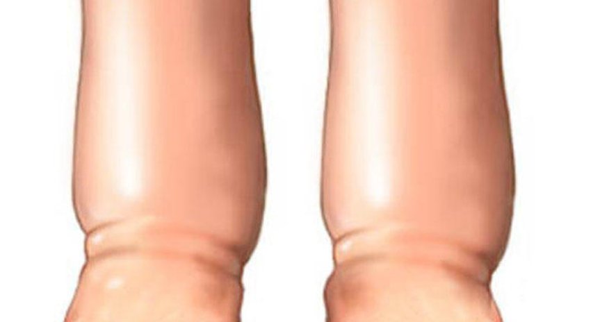 Ayaqların şişməsi hansı dəhşətli xəstəliyin əlamətidir?