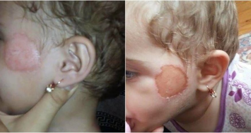 Bağçada uşağın üzünə dağ basdığı iddia edilən müəllimədən xəbər var