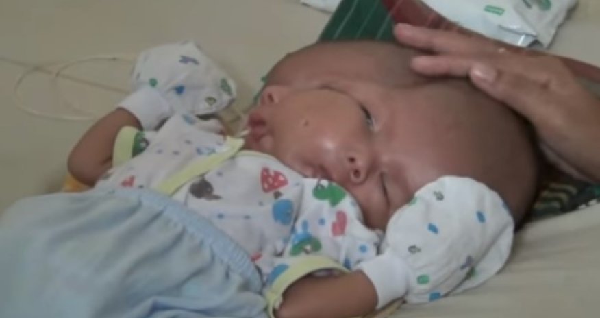 İki üzü olan körpə doğuldu – Video