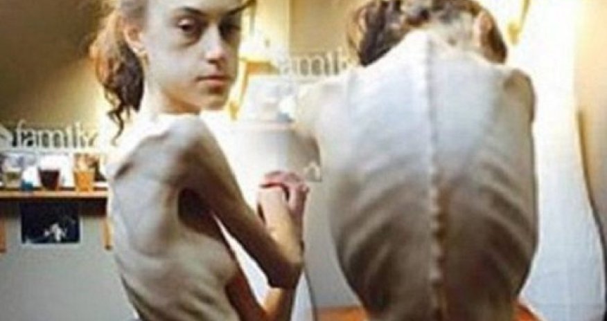 Pəhriz saxladı, bu hala düşdü -  FOTOLAR