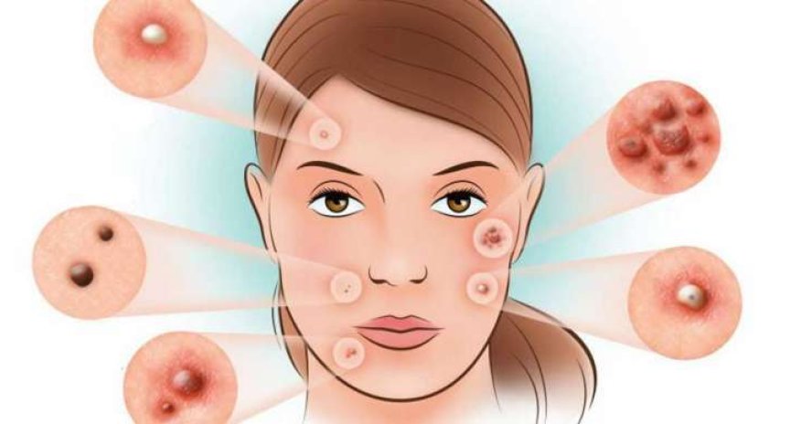 Bu sızanaqları sıxmayın - İflic Ola Bilərsiniz! - VİDEO