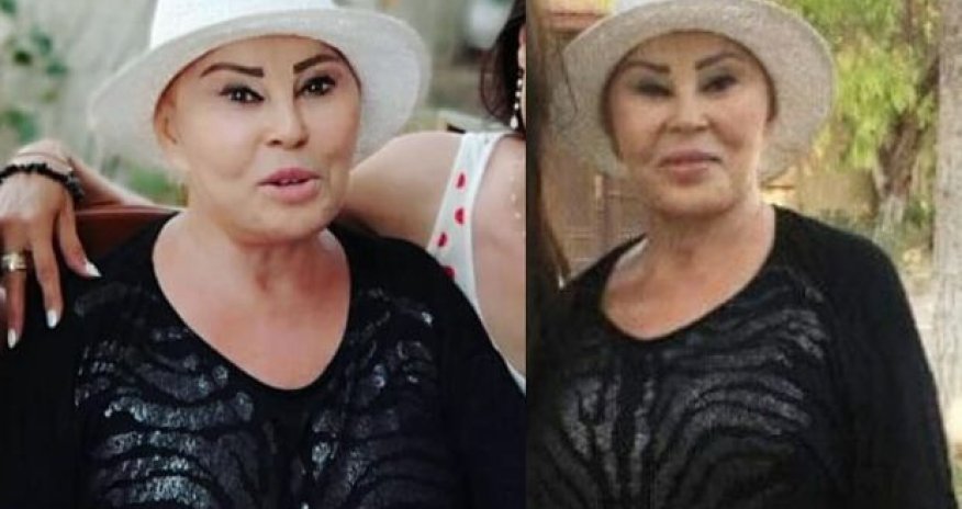 Kimyaterapiyadan üzü şişdi, saçları töküldü, parik taxdı... - Amaliya Pənahovanın son rolu