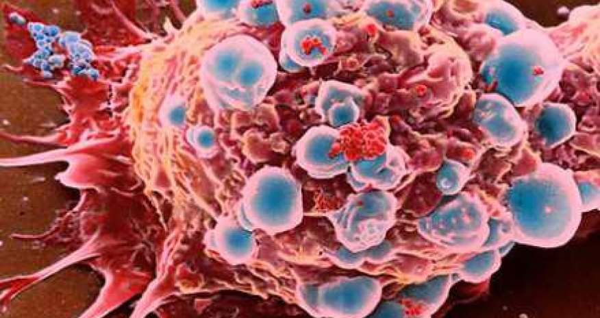 Xalq artistinə səhvən xərçəng diaqnozu qoyuldu - Kimya verildi, narkozsuz əməliyyat olundu