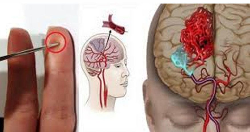 İnsult keçirən xəstəni bu cür xilas edin - Çinli həkimin metodu