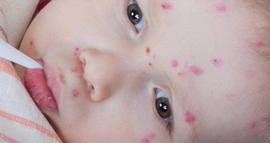 Uşaqlarda suçiçəyi xəstəliyi